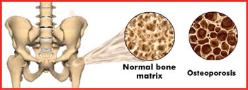 osteoporosis-calcium